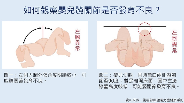孩子換尿布髖關節發出怪聲 父母觀察2大重點及早診治 