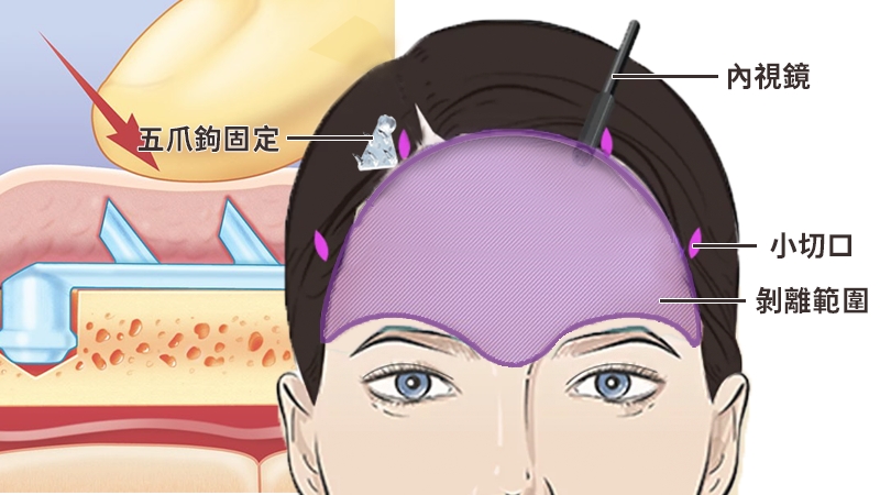 告別眉毛下垂與八字眉！內視鏡提眉手術揭密：3大優點＋5大照護關鍵