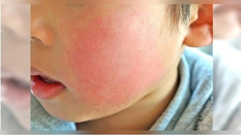 臉頰發紅要注意！日本「蘋果病」增加　醫：3族群應特別小心