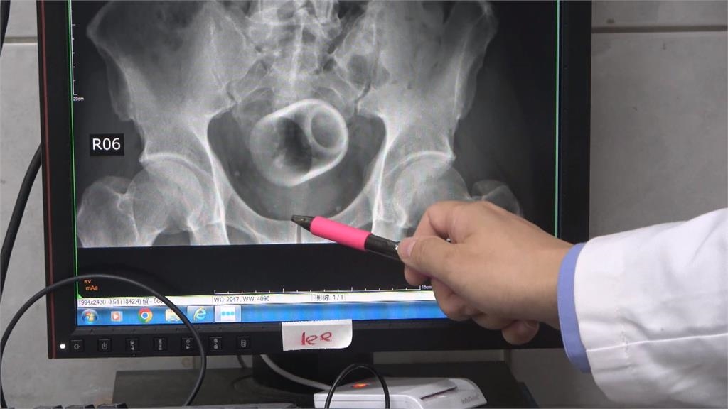 男腹痛難耐3天以上沒解便　醫驚見骨盆腔有「這東西」