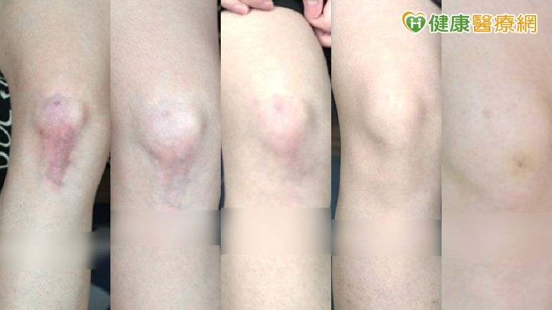 傷口癒合不是結束 預防疤痕從「這時機」開始!醫揭疤痕凝膠應用策略