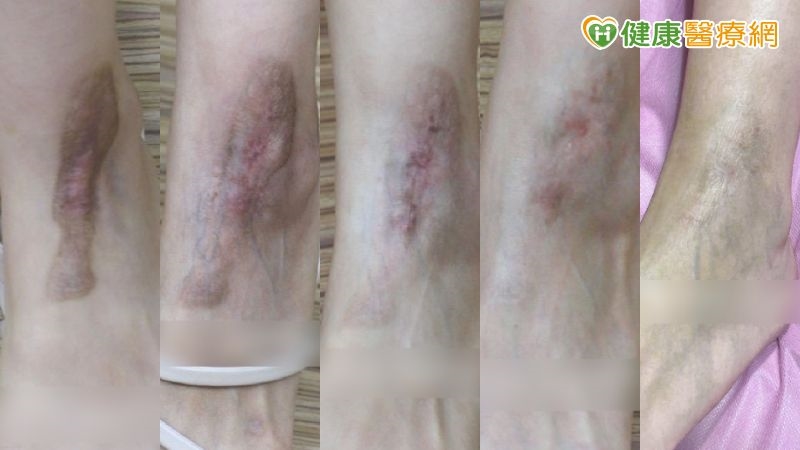 傷口癒合不是結束 預防疤痕從「這時機」開始!醫揭疤痕凝膠應用策略