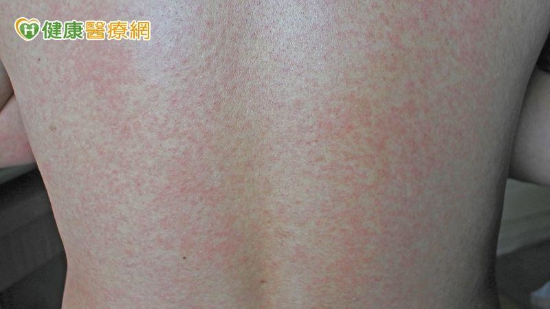 紅斑性狼瘡冬季容易惡化？中醫師提醒　飲食與循環調理重點