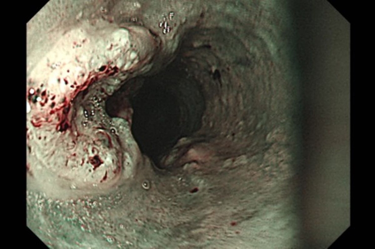 食道癌不用大開胸？ 微創技術降低併發症、縮短恢復期