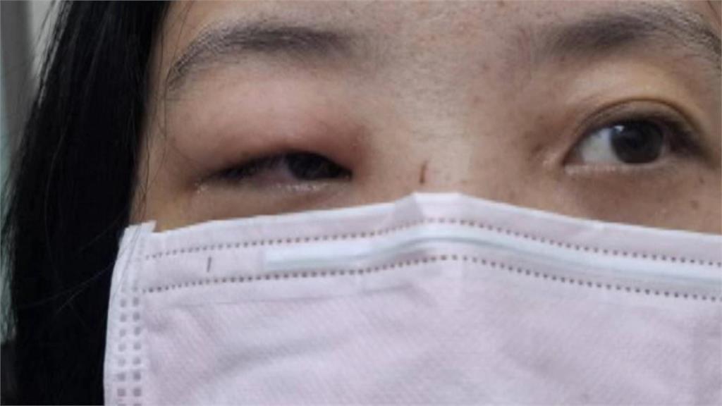 騎機車遭「蜜蜂攻擊」！　女子眼眶染蜂窩性組織炎