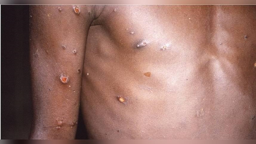 M痘疫情持續！11月新增7例「皆本國青壯男性」　全台案例分布曝光