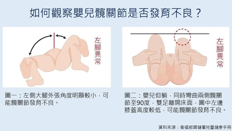 孩子換尿布有咔嗒怪聲?醫:恐是髖部問題 及早發現避免終生跛行