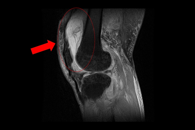 長期膝痛竟是結核菌感染 老翁清創加抗結核藥救回關節