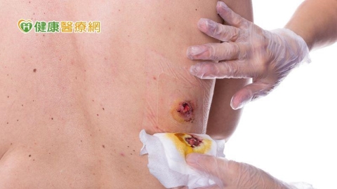 長期臥床壓瘡惡化正悄悄發生！醫：減壓、營養與敷料正確使用缺一不可