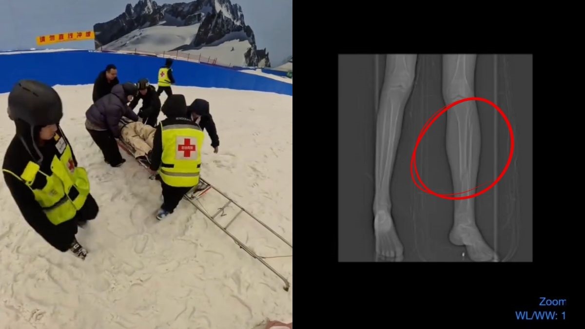 圖／女子在加速時身體重心不穩，下一秒便向前傾倒，腿部遭扭轉，當場痛苦倒地，隨後即被送往醫院救治。（翻攝 xinpengjilin Instagram）