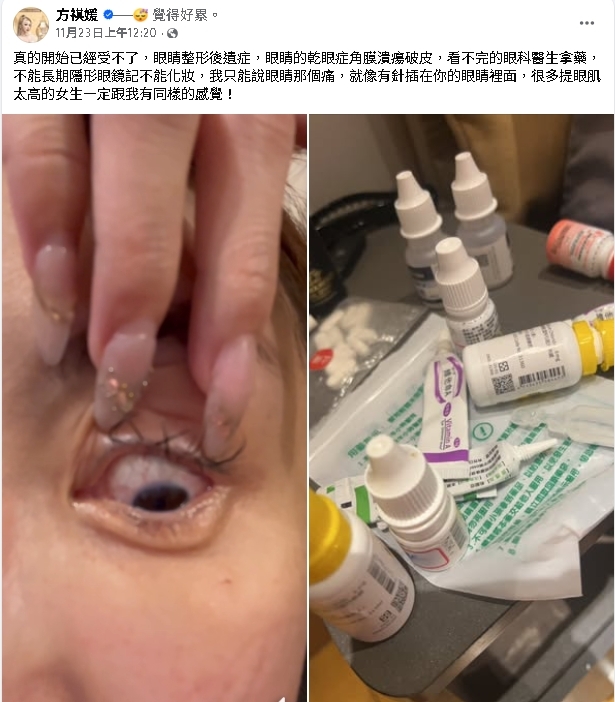 雪碧砸近千萬整形「眼睛留下後遺症」！她崩潰喊「像被針插」慘況曝光