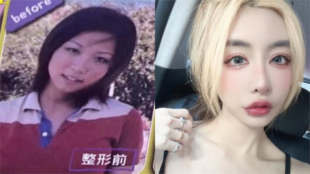 雪碧砸近千萬整形「眼睛留下後遺症」！她崩潰喊「像被針插」慘況曝光