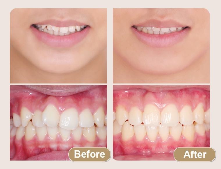 青少年矯正不嫌晚! 隱形牙套搭「遠端監控」成新趨勢