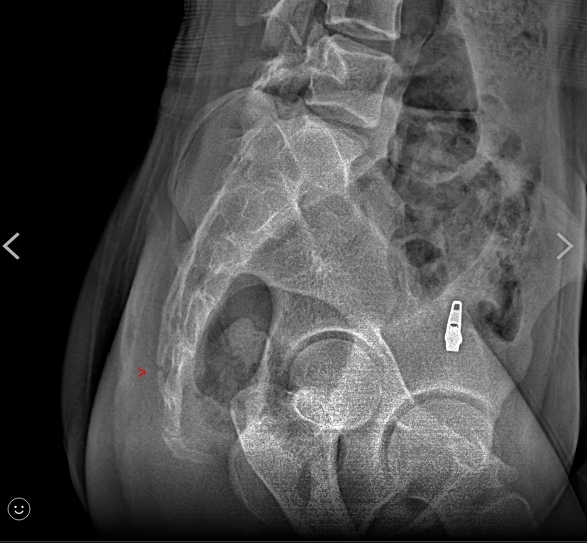 桃園國二生練啦啦隊慘摔骨折 家長痛批