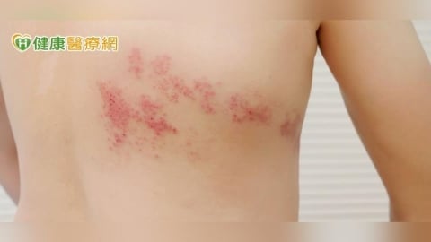 背痛到像被火燒竟是帶狀皰疹!醫:「這樣做」可大幅降低復發與後遺症