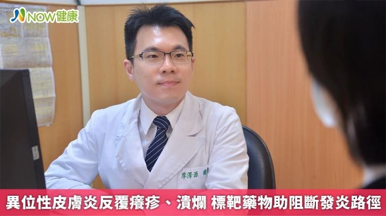 異位性皮膚炎反覆癢疹、潰爛 標靶藥物助阻斷發炎路徑