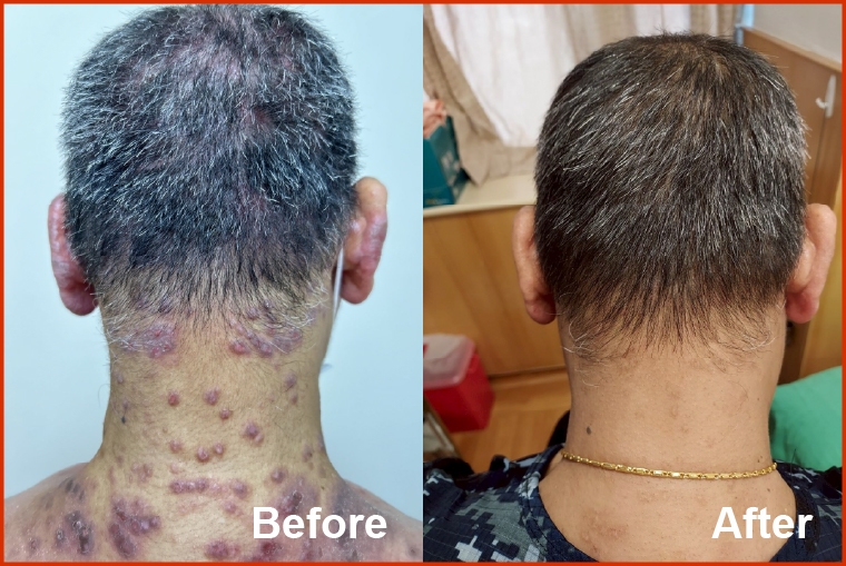 異位性皮膚炎反覆癢疹、潰爛 標靶藥物助阻斷發炎路徑