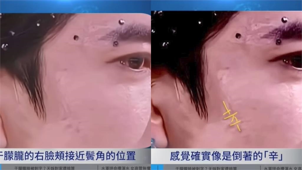 于朦朧遭爆「戴矽膠假耳」畫面曝！他曬右臉「辛」字烙印照：盼于粉出面