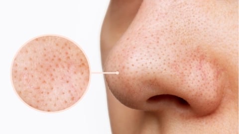 皮脂管絲不是黑頭粉刺!解析兩者差異與三種日常護理方式