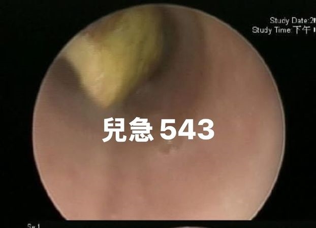1歲嬰吃芭樂「卡氣管」險喪命！釀吸入性肺炎進ICU　幼兒進食留意3點