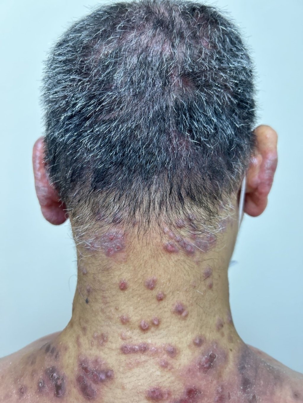 全台29萬人罹患異位性皮膚炎！標靶藥物治療成嶄新契機！