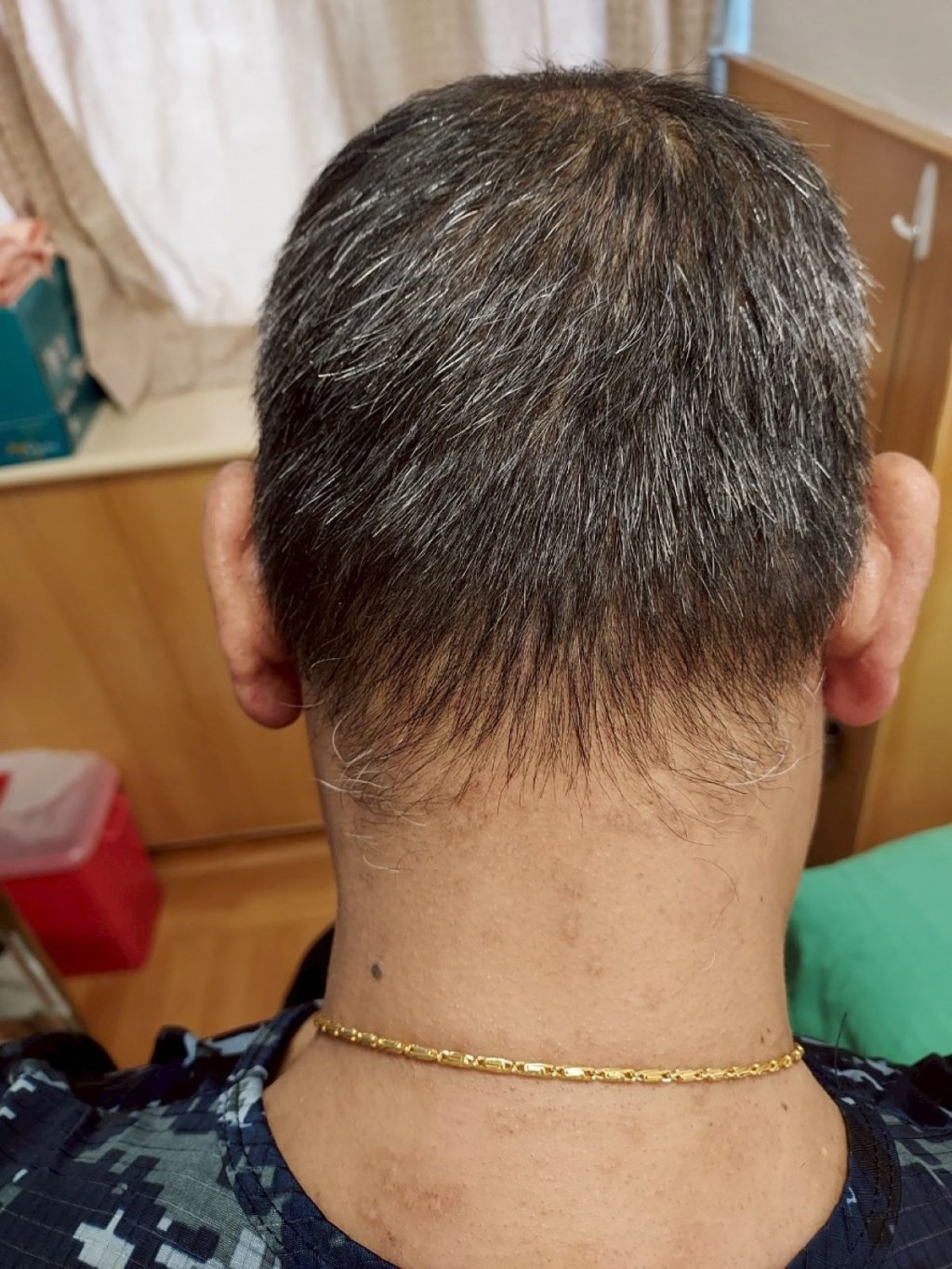 全台29萬人罹患異位性皮膚炎！標靶藥物治療成嶄新契機！