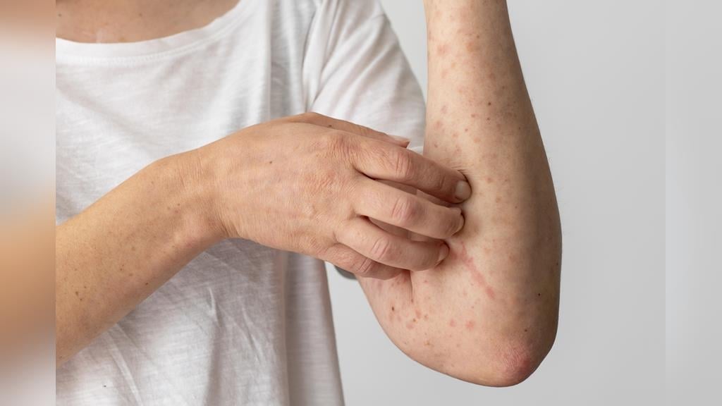 全台29萬人罹患異位性皮膚炎！標靶藥物治療成嶄新契機！