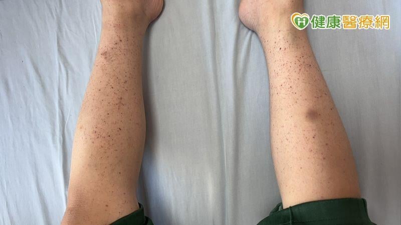 8歲童全身冒小血斑、剔牙大出血　竟是「免疫性紫斑症」險致命