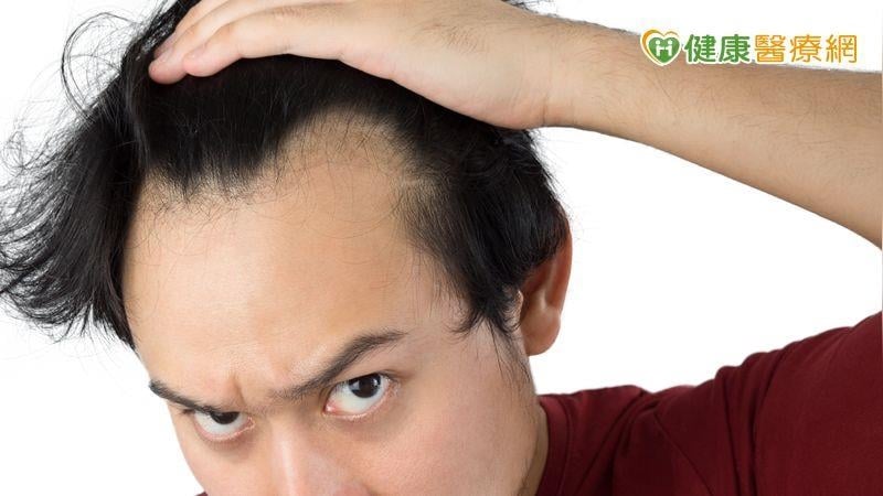 35 歲男髮際線後退「M型禿」！中醫「1治療」改善掉髮、新髮冒出