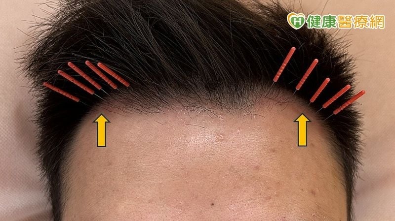 35 歲男髮際線後退「M型禿」!中醫「1治療」改善掉髮、新髮冒出