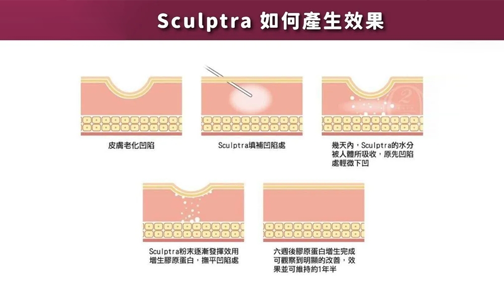 【Sculptra 童妍針】PLLA 原理、施作流程與常見問題解析