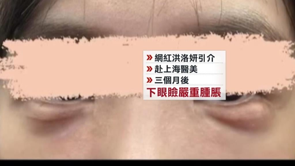 網紅洪洛妍「仲介中國醫美」鬧糾紛！　女花逾11萬元動刀遭毀眼