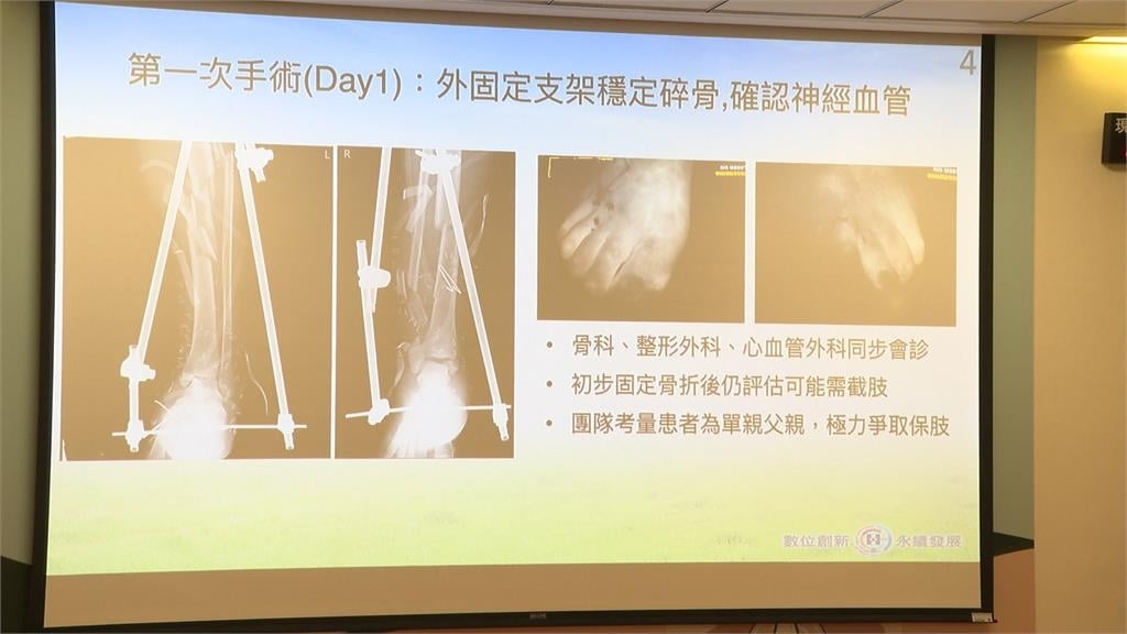連環車禍雙側小腿"最嚴重骨折" 單親爸12次手術保住雙腳