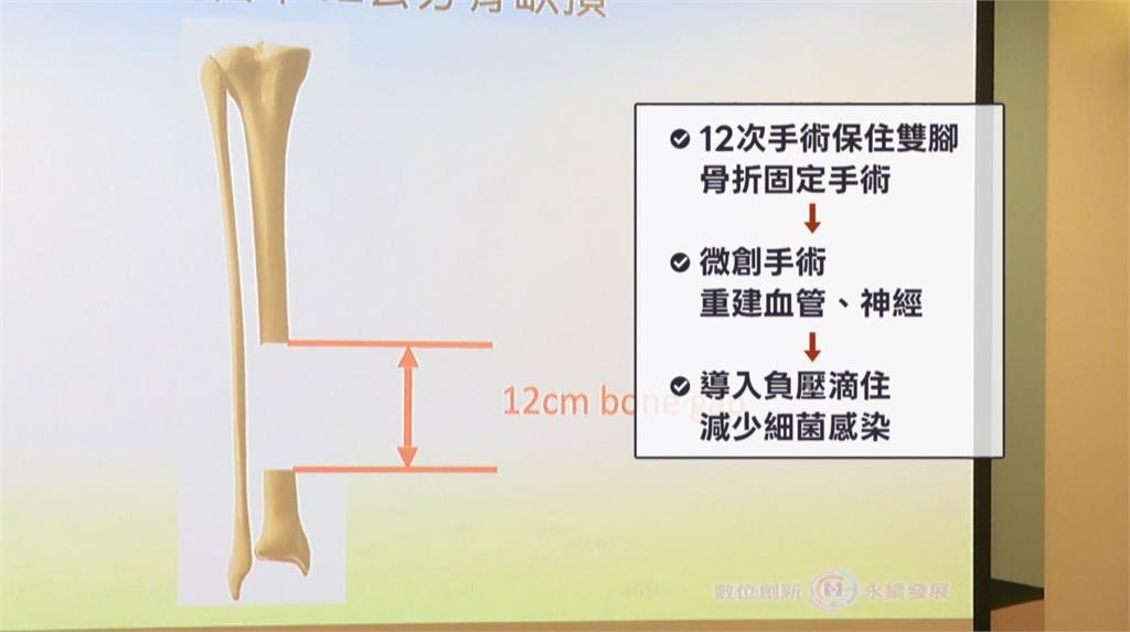 連環車禍雙側小腿"最嚴重骨折" 單親爸12次手術保住雙腳