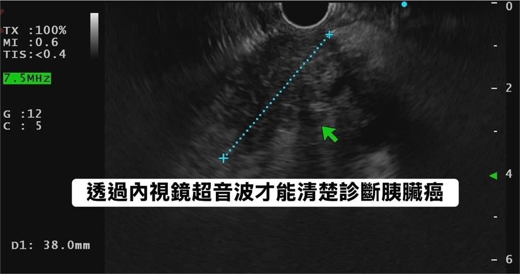 半年瘦10公斤「女腹痛就醫」胃沒問題！醫見2症狀「一照胰臟」已是三期癌