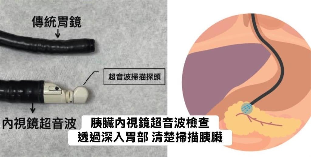 半年瘦10公斤「女腹痛就醫」胃沒問題！醫見2症狀「一照胰臟」已是三期癌