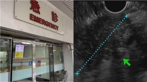 半年瘦10公斤「女腹痛就醫」胃沒問題！醫見2症狀「一照胰臟」已是三期癌