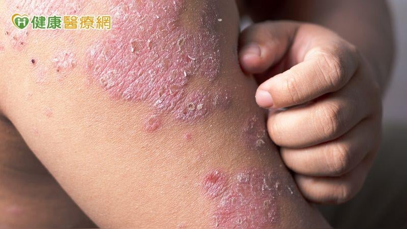抓到滿身傷還治不好？醫揭「異位性皮膚炎關鍵解方」重拾生活品質