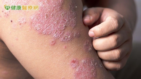 抓到滿身傷還治不好？醫揭「異位性皮膚炎關鍵解方」重拾生活品質