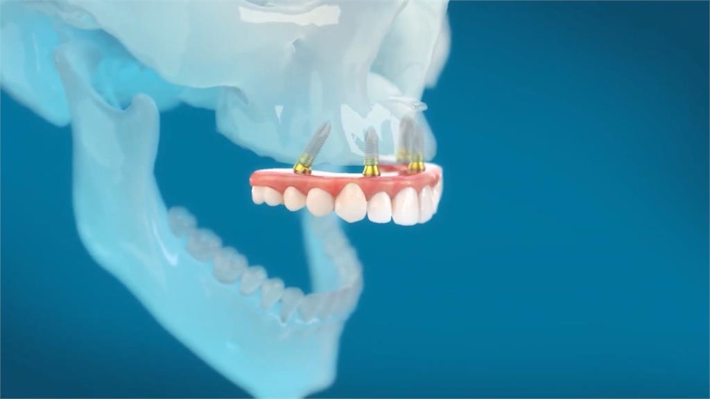 精準植牙時代來臨 「ALL-on-4」植牙十年維持率逾9成