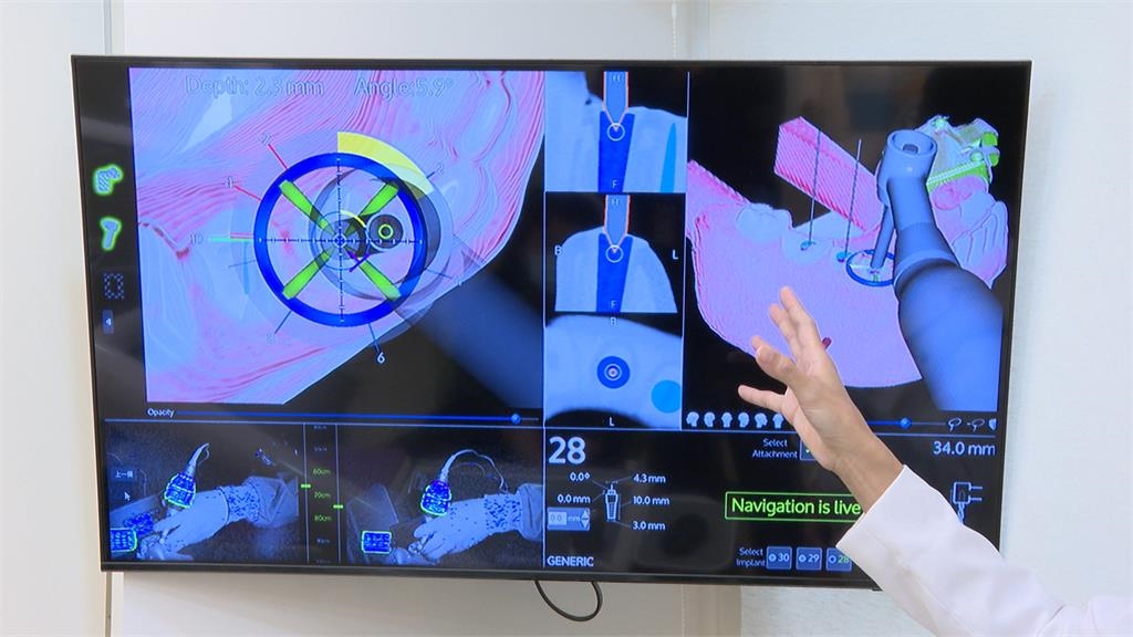 精準植牙時代來臨　「ALL-on-4」植牙十年維持率逾9成