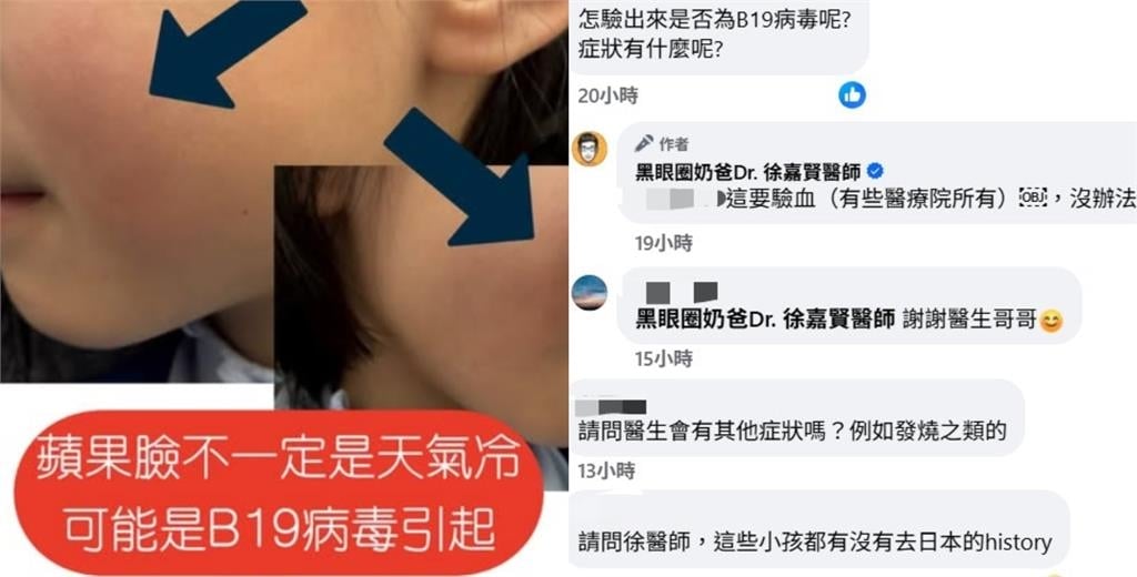 冬天臉頰泛紅「像被打巴掌」竟不是過敏!醫籲「蘋果病」症狀:易被忽略