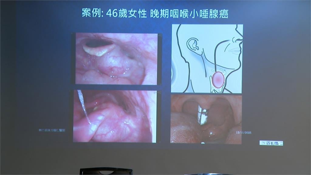 咽喉小唾腺癌恐要拿掉聲帶　用單孔達文西手術救回