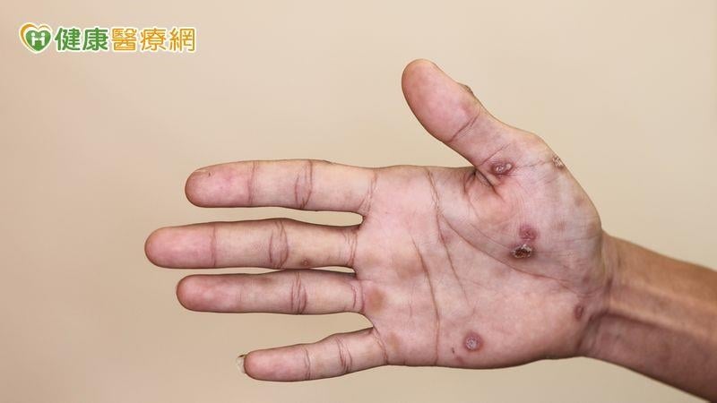 手腳紅斑不癢！他問AI竟罹「梅毒二期」　醫點頭揭成因
