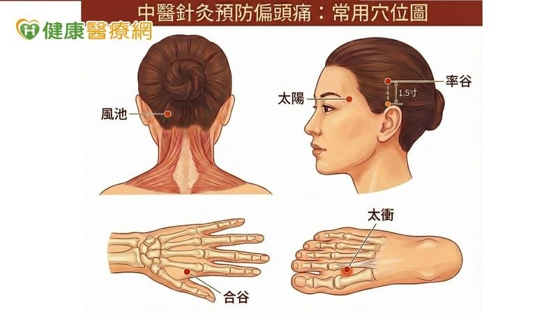 偏頭痛老是復發？中醫針灸有助預防發作、減少止痛藥服用頻率