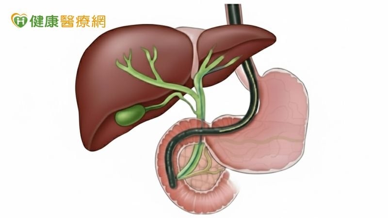 膽結石、膽管結石傻傻分不清 醫解析「症狀與治療」差異