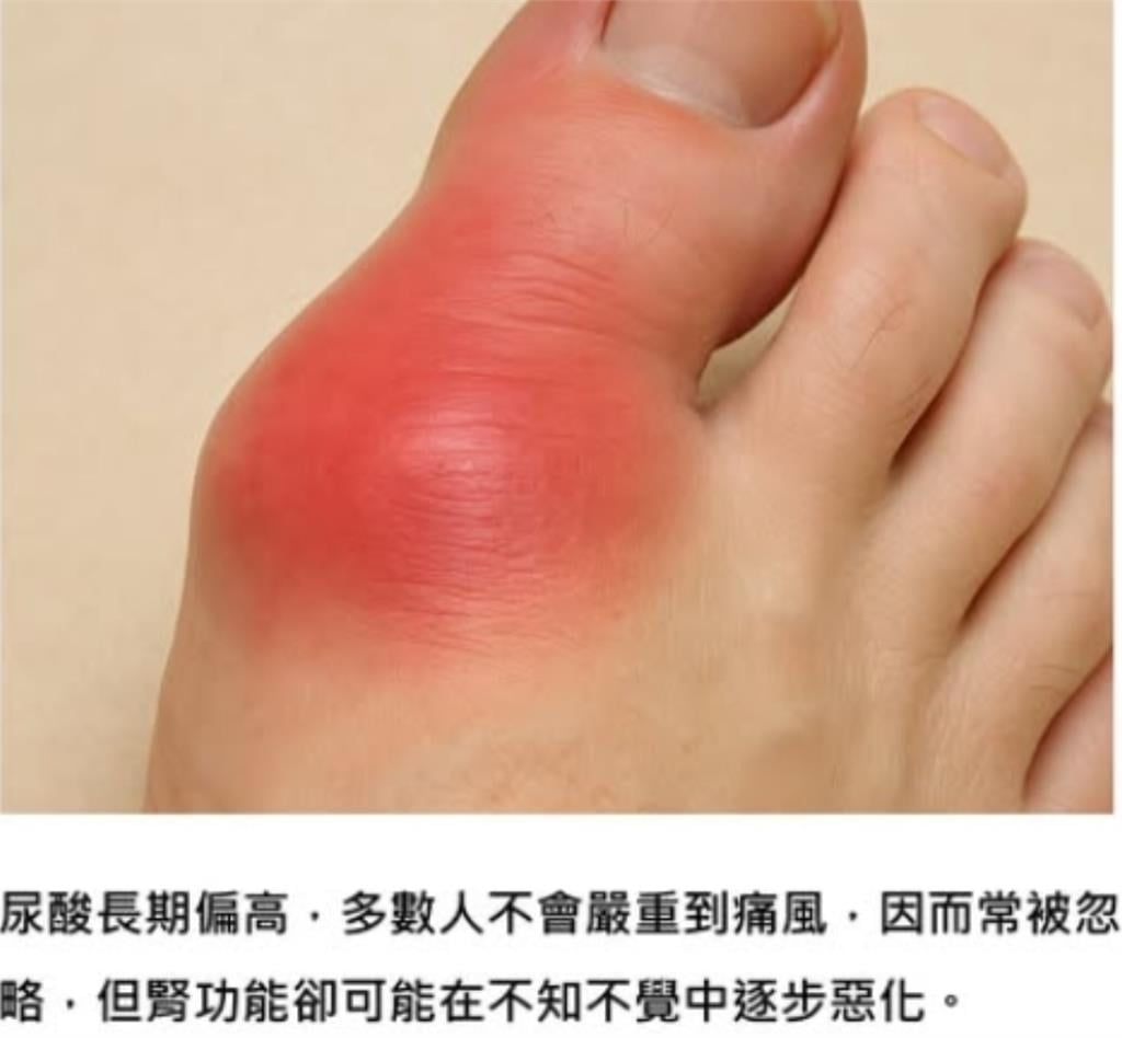 身體「4警訊」要注意…尿酸長期偏高、無症狀恐淪「1慢性病」風險因子!