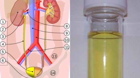 身體「4警訊」要注意…尿酸長期偏高、無症狀恐淪「1慢性病」風險因子!
