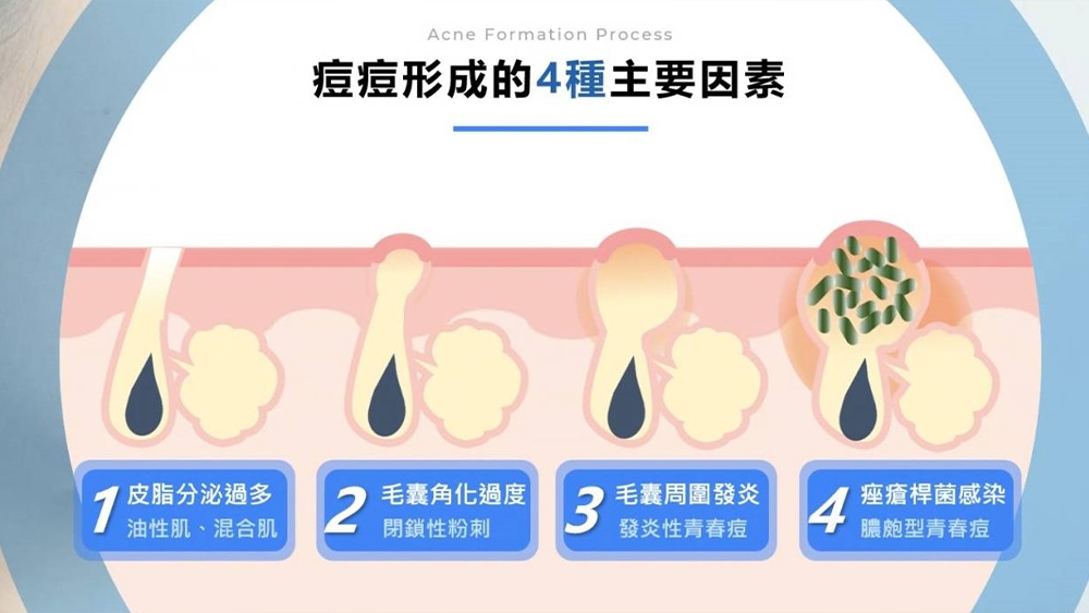 臉部有痘痘時,適合接受雷射相關皮膚照護嗎?