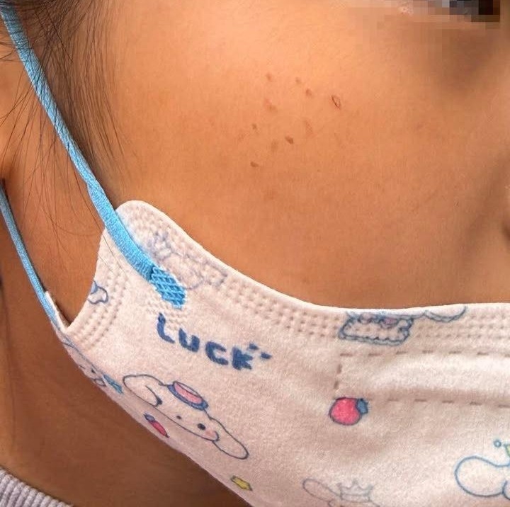 女童臉上驚見「紅疹排排站」誤當被蟲咬 醫曝「這1物」惹的禍:換掉才會好!